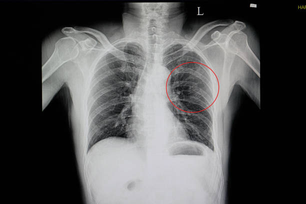 a chest x-ray of a blunt chest wall injuried a chest x-ray of a blunt chest wall injuried patient showing fractured ribs 5, 6, 7, 8 on the left side(red cycle) with some pulmonary contusion bone fracture stock pictures, royalty-free photos & images
