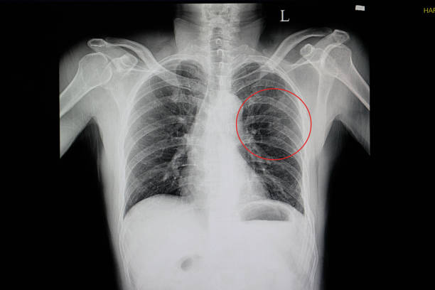 a chest x-ray of a blunt chest wall injuried a chest x-ray of a blunt chest wall injuried patient showing fractured ribs 5, 6, 7, 8 on the left side(red cycle) with some pulmonary contusion x ray rib cage stock pictures, royalty-free photos & images