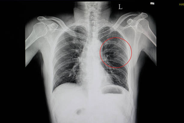 a chest x-ray of a blunt chest wall injuried a chest x-ray of a blunt chest wall injuried patient showing fractured ribs 5, 6, 7, 8 on the left side(red cycle) with some pulmonary contusion ribs stock pictures, royalty-free photos & images