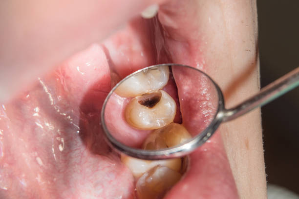 karies verwöhnte zahn nahaufnahme fotografiert - dentist pain human teeth toothache stock-fotos und bilder