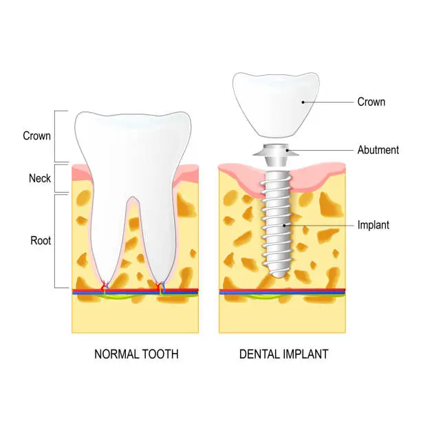 Vector illustration of Dental implant, and Normal tooth