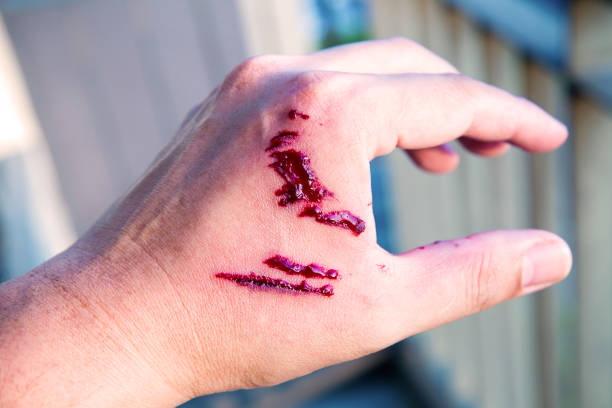 247 Dog Bite Wound Stock Photos, Pictures & Royalty-Free Images - iStock