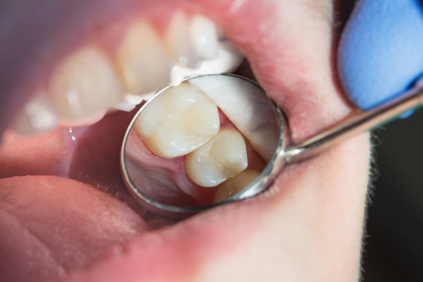 istock caries spoiled tooth closeup photographed 926234454