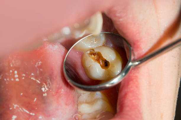 istock caries spoiled tooth closeup photographed 926234870
