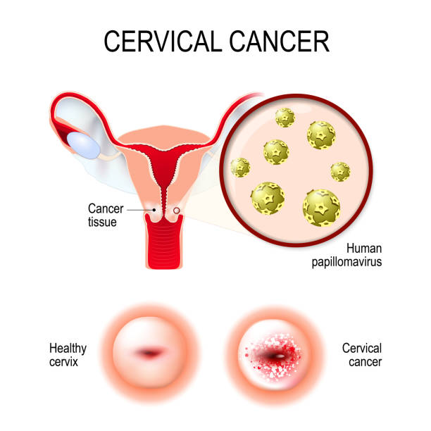 Cervical cancer. uterus, cervix, and close-up of the Human papil Cervical cancer. vector illustration of the uterus and cervix. Close-up of the Human papillomavirus infection (HPV) that causes diseases. female reproductive system pap smear stock illustrations