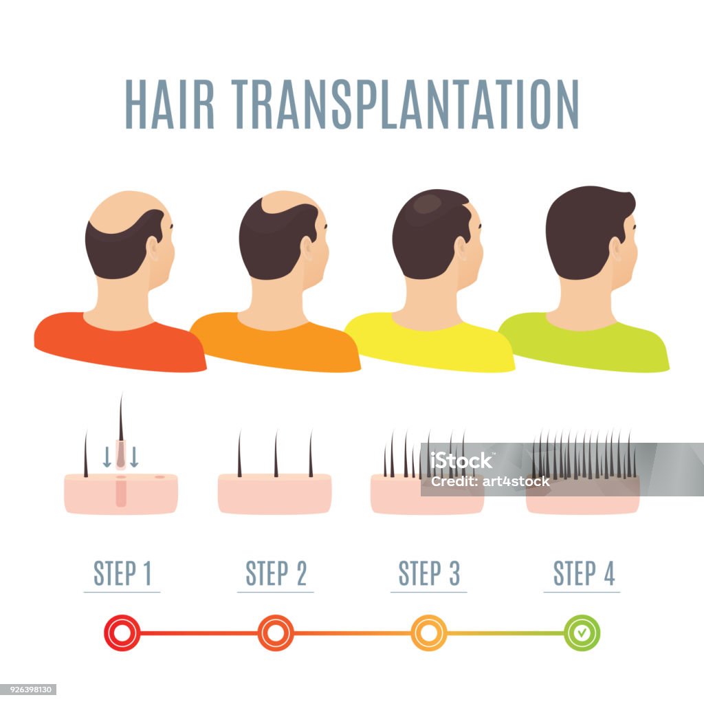 Hair Transplantation 4 Steps Infographics Stock Illustration - Download  Image Now - Growth, Hair, Hair Transplant - iStock
