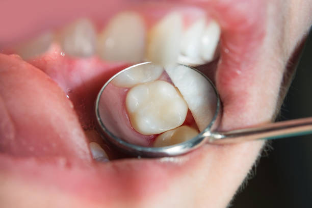 istock caries spoiled tooth close-up photographed 926502648