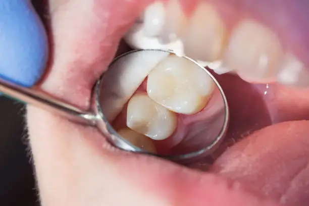 close-up of a human rotten carious tooth at the treatment stage in a dental clinic. The use of rubber dam system with latex scarves and metal clips, production of photo polymeric composite fillings