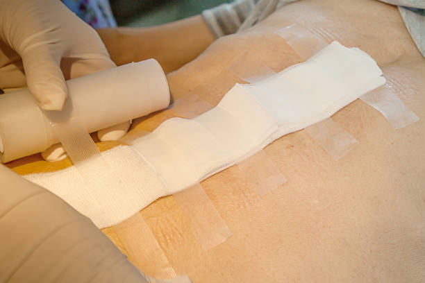 istock Abdomen scar after surgery 926509662