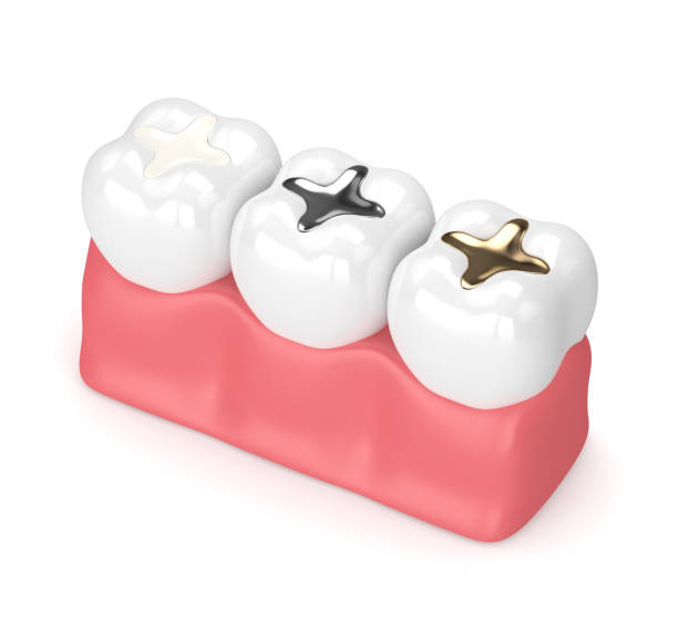 istock 3d render of teeth with different types of dental filling 926536800