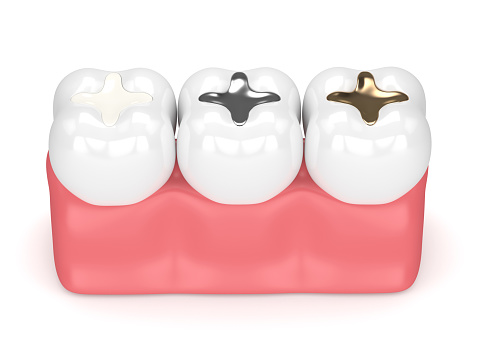 3D render de los dientes con diferentes tipos de relleno dental photo