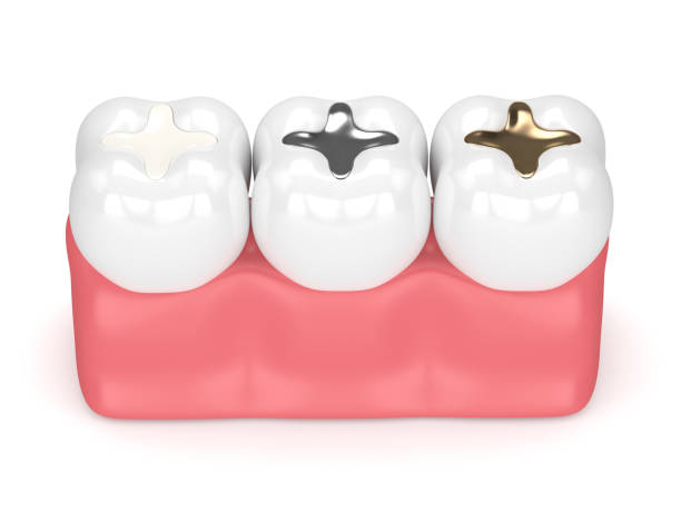 3d render de los dientes con diferentes tipos de relleno dental - filling fotografías e imágenes de stock
