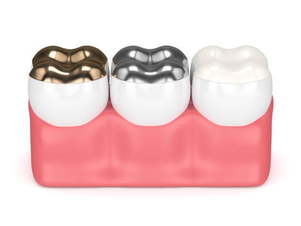 istock 3d render of teeth with different types of dental filling 926551300