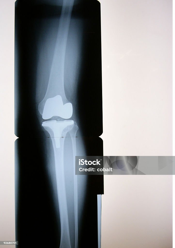 人工膝関節 X 線 - 人工膝関節のロイヤリティフリーストックフォト