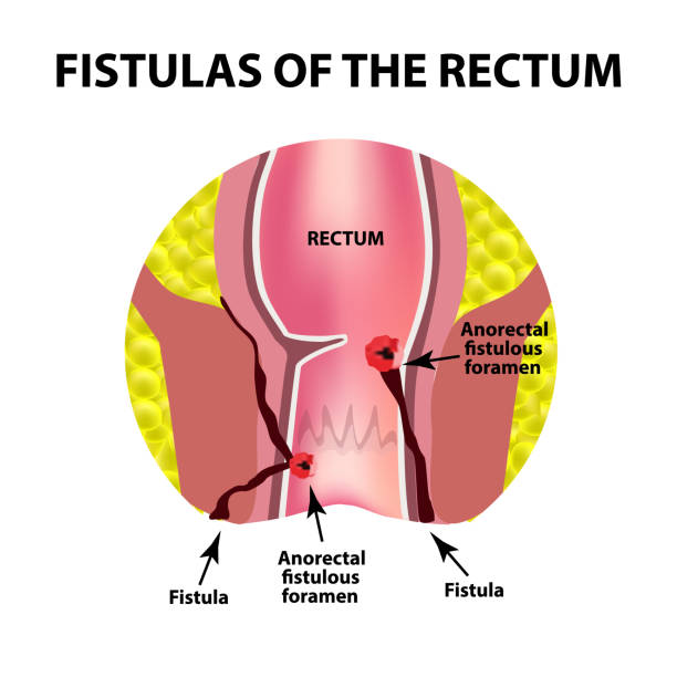 Types of fistulas of the rectum. Paraproctitis. Anus. Abscess of the rectum. Infographics. Vector illustration on isolated background Types of fistulas of the rectum. Paraproctitis. Anus. Abscess of the rectum. Infographics. Vector illustration on isolated background. anus stock illustrations