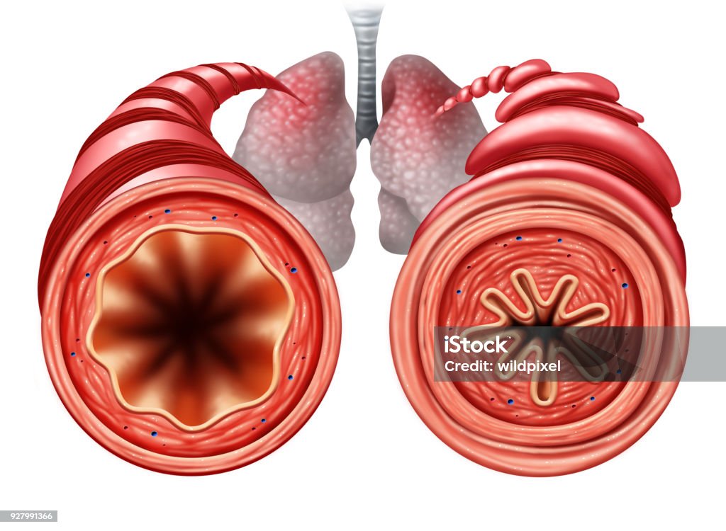 Asthma Diagram Asthma diagram as a healthy and unhealthy bronchial tube with a constricted breathing  problem caused by respiratory muscle tightening with 3D illustration elements. Asthmatic Stock Photo