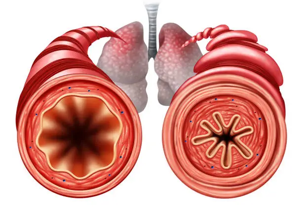 Asthma diagram as a healthy and unhealthy bronchial tube with a constricted breathing  problem caused by respiratory muscle tightening with 3D illustration elements.