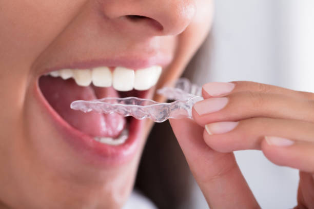 istock Woman's Hand Putting Transparent Aligner 928069660