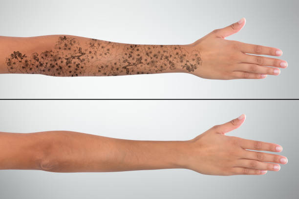 istock Woman's Hand Before And After Laser Tattoo Removal 928069664