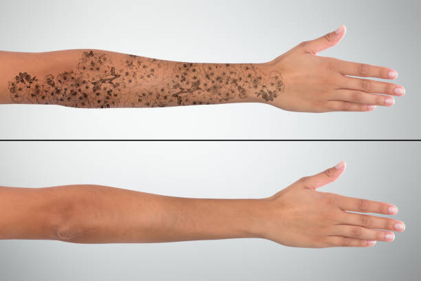 Woman's Hand Before And After Laser Tattoo Removal Close-up Of Woman's Hand Before And After Laser Tattoo Removal Treatment back shoulder tattoos for women pictures stock pictures, royalty-free photos & images