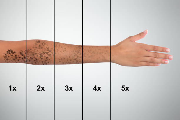 istock Tattoo Removal On Woman's Hand 928069666