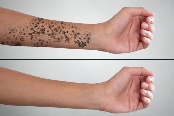 mano della donna prima e dopo la rimozione del tatuaggio laser - arm tattoo foto e immagini stock