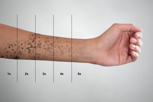 istock Tattoo Removal On Woman's Hand 928069682