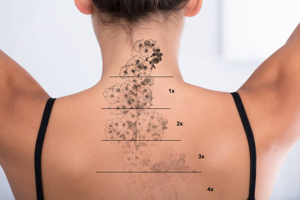 Tattoo Removal On Woman's Back Laser Tattoo Removal On Woman's Back Against White Background workplace absence stock pictures, royalty-free photos & images
