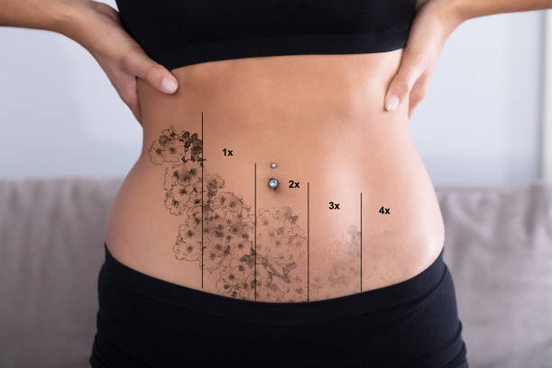Close-up Of Laser Tattoo Removal On Woman's Stomach With Piercing