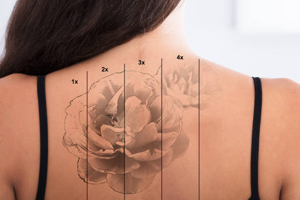 istock Laser Tattoo Removal On Woman's Back 928069700