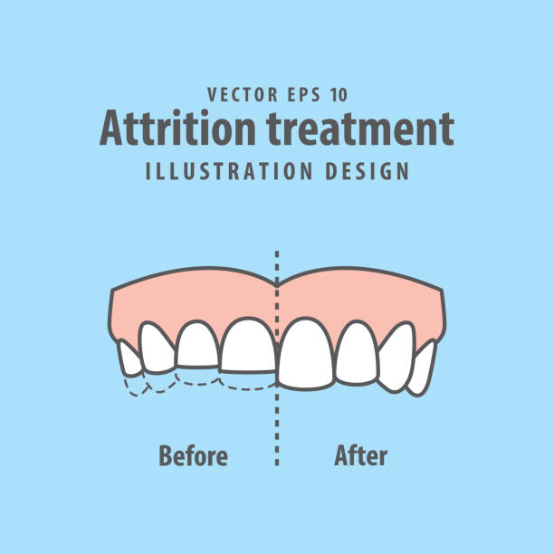 illustrations, cliparts, dessins animés et icônes de attrition traitement comparaison illustration vectorielle sur fond bleu. concept dentaire. - dentist symbol human teeth healthcare and medicine