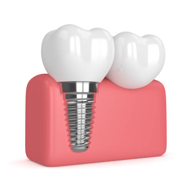 3d render of implant with dental cantilever bridge 3d render of implant with dental cantilever bridge in gums  isolated over white background cantilever bridge stock pictures, royalty-free photos & images