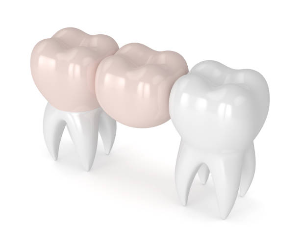 istock 3d render of teeth with dental cantilever bridge 928229958