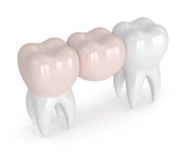 istock 3d render of teeth with dental cantilever bridge 928234888