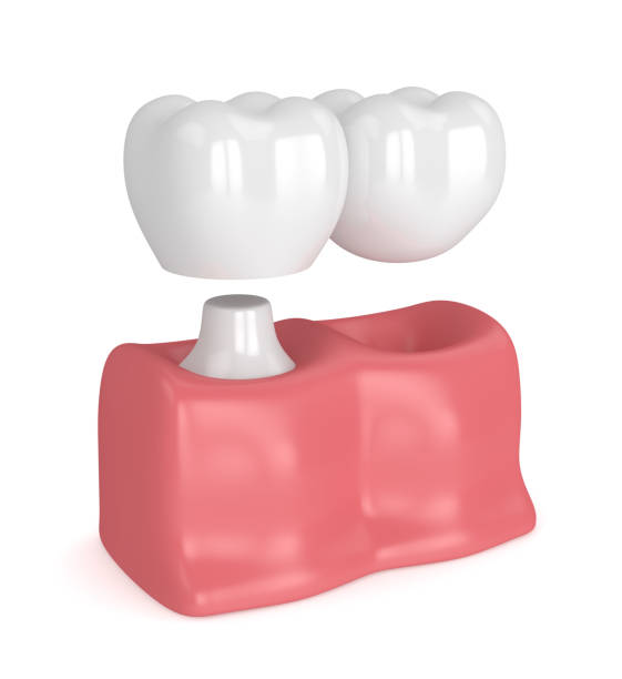 3d render of teeth with dental cantilever bridge - vertical lift bridge imagens e fotografias de stock