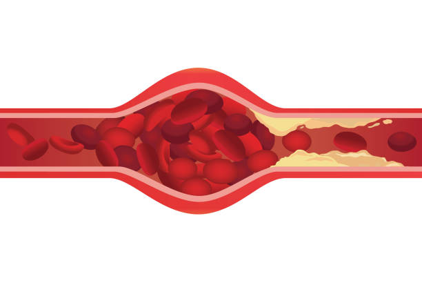 tętnic obrzęk, ponieważ tłuszcz cloged wykonane przepływ krwi powoli. - cholesterol atherosclerosis human artery illness stock illustrations