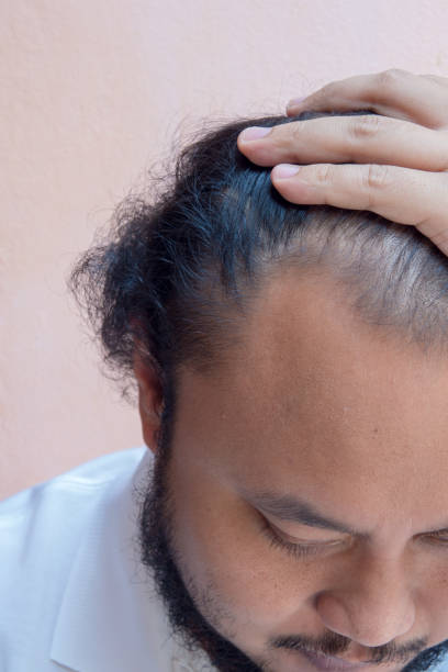 istock closeup of hair lose 928695652