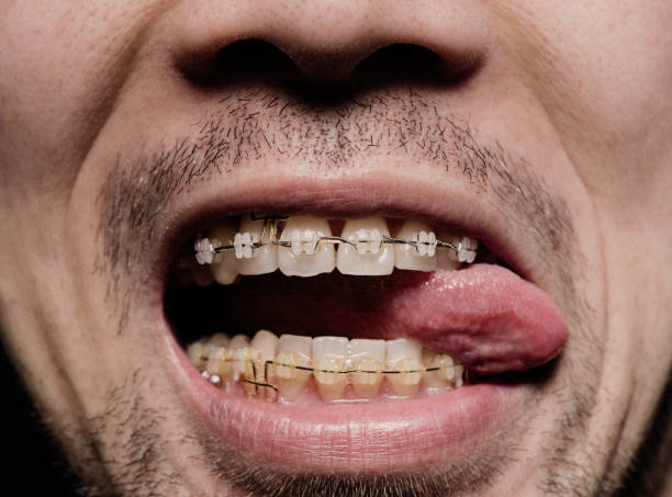 istock Close-up of a man's mouth, orthodontics 928783854