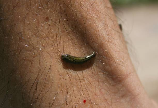 Leech Rash 120+ Leech On Human Skin Stock Photos, Pictures & Royalty-Free Images ...