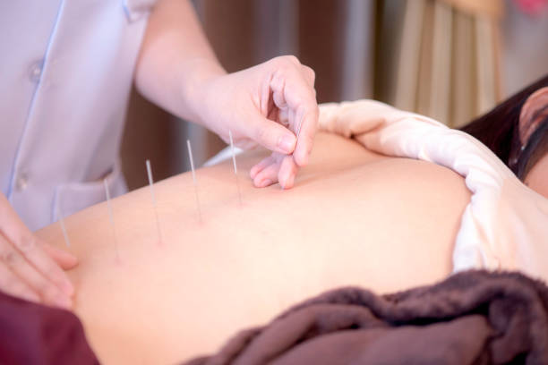 The physiotherapist is doing acupuncture on the back of a female patient. Patient is lying down on a bed. stock photo