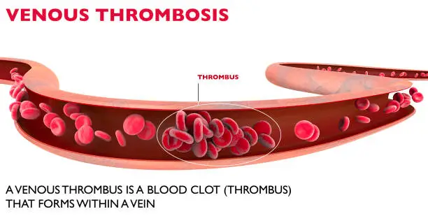 Photo of Venous thrombosis, red blood cells, erythrocyte cell, blood, hemoglobin, oxygen transport, transport, lungs, tissues, carbon dioxide, gas expulsion, human body, analysis, microscope, research, study, without nucleus, mammals, blood group, white background