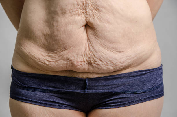 крупным планом на избыток кожи живота женщины после потери большого веса - overweight tummy tuck abdomen body стоковые фото и изображения