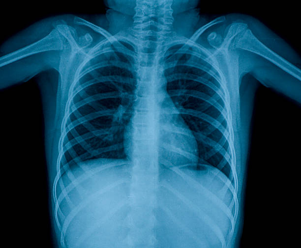 istock Chest X-ray image of child 92949613
