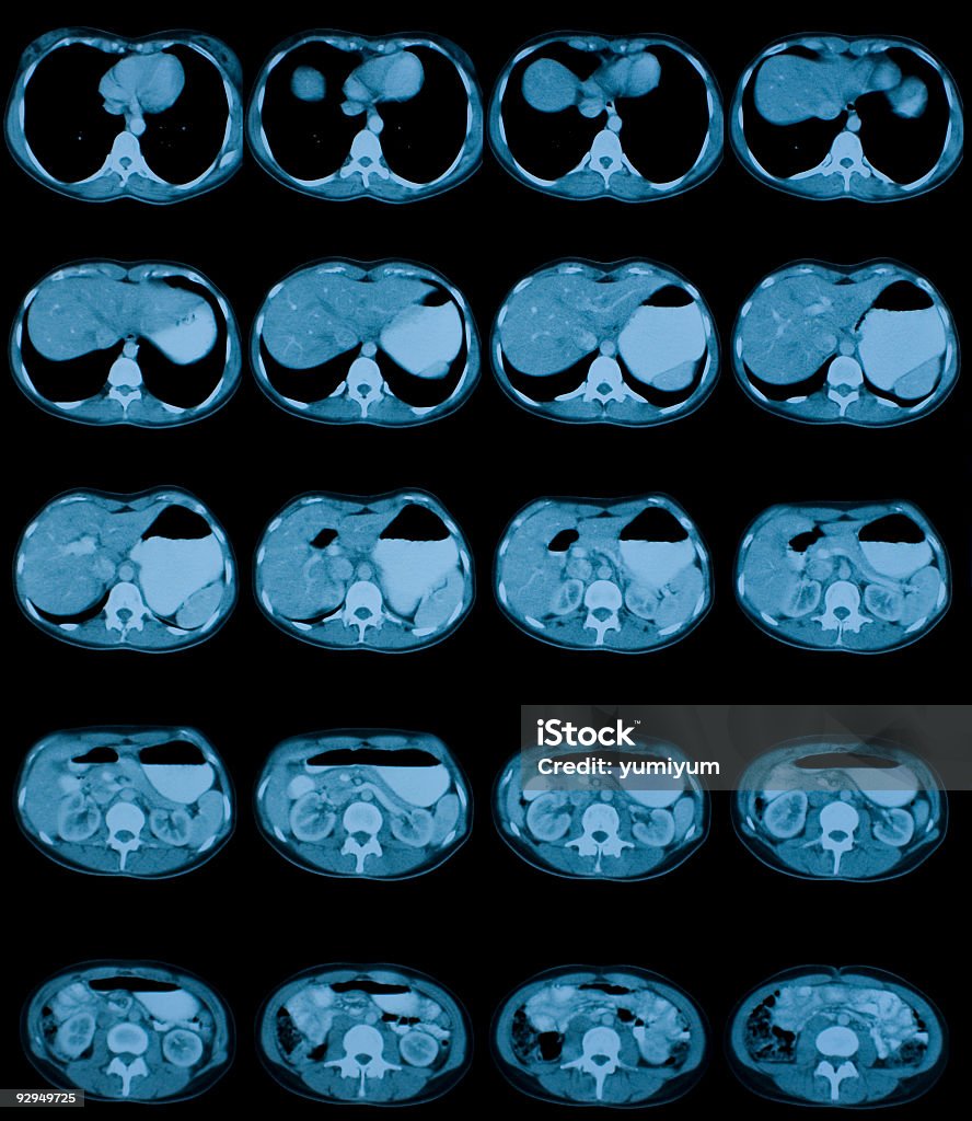 Abdômen CT scan - Foto de stock de Tomografia Computadorizada royalty-free