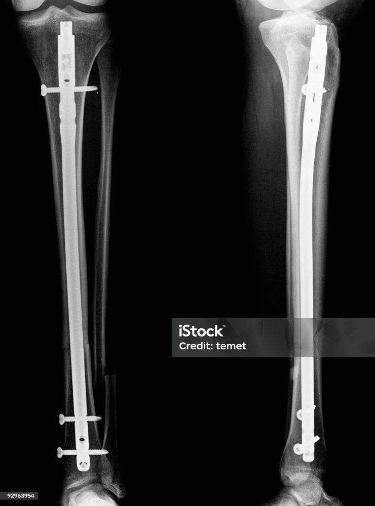 X-ray imágenes de tibia y de peroné - Foto de stock de Anatomía libre de derechos