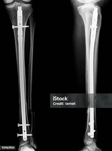 Xray Imágenes De Tibia Y De Peroné Foto de stock y más banco de imágenes de Anatomía - Anatomía, Cirugía, Color - Tipo de imagen