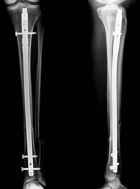 istock X-ray images of tibia and fibula 92963954