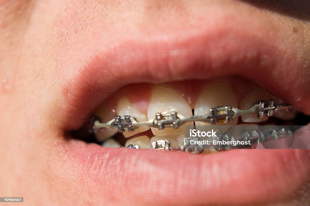 Aparat ortodontyczny - Zbiór zdjęć royalty-free (Anatomia człowieka)