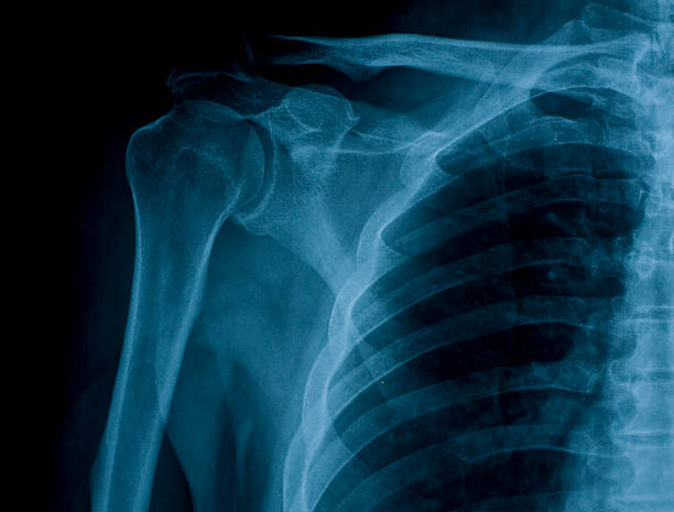 istock x-ray image of right shoulder 92980386