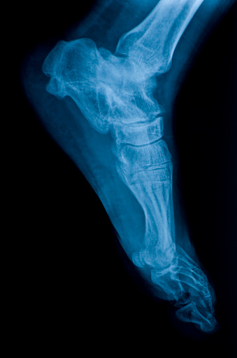 X-ray image of foot